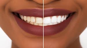 Smile makeover before and after