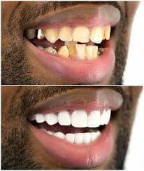 Professional teeth cleaning results