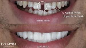 Dental veneers transformation