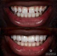 Hollywood smile makeover