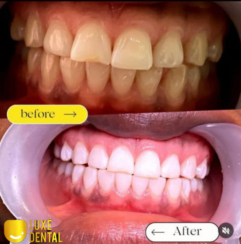 Cosmetic dental bonding before after