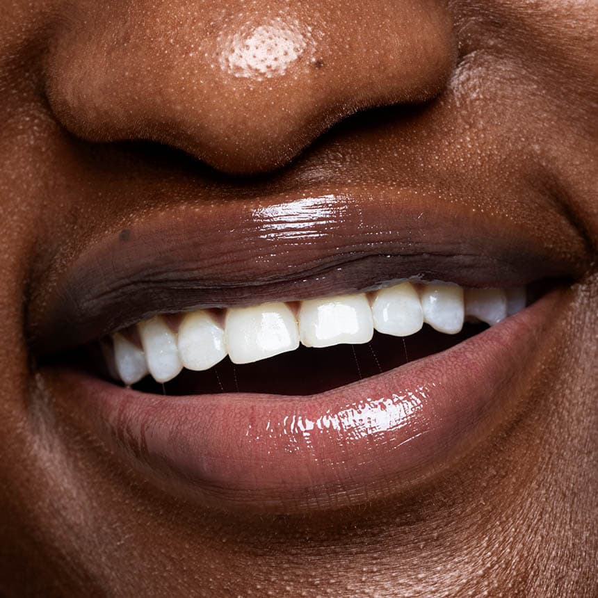 Cosmetic dental bonding before after