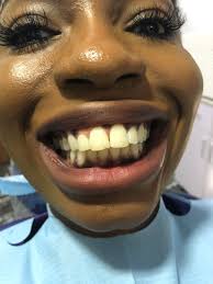 Hollywood smile makeover