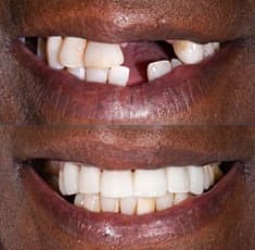 Dental veneers transformation